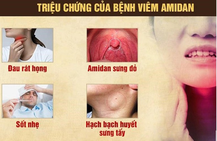 Bệnh viêm amidan: Nguyên nhân, dấu hiệu và cách điều trị - Ảnh 1.