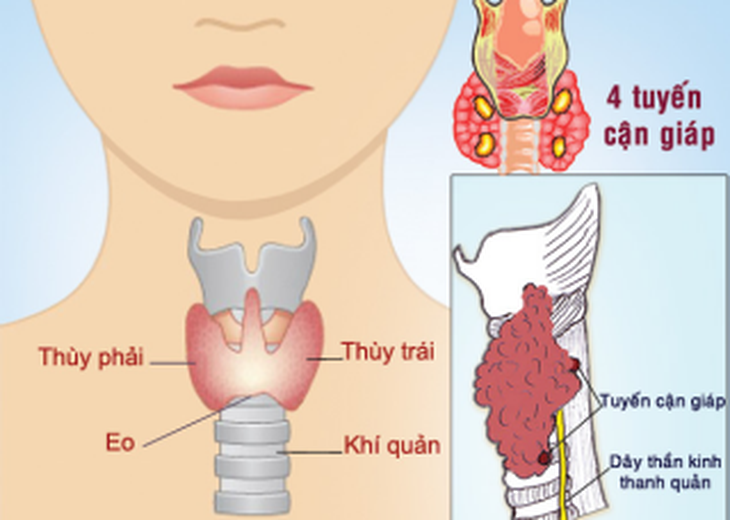 U tuyến cận giáp: Những điều cần biết để tránh tàn phế - Ảnh 2.