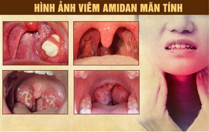 Viêm amidan mạn tính là gì? Cách điều trị và phòng ngừa tái phát - Ảnh 1.