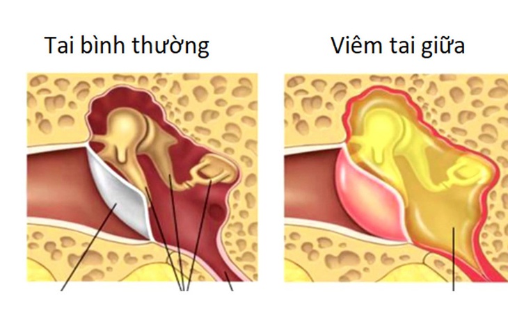 Viêm tai giữa mạn tính ở người lớn có nên phẫu thuật không?