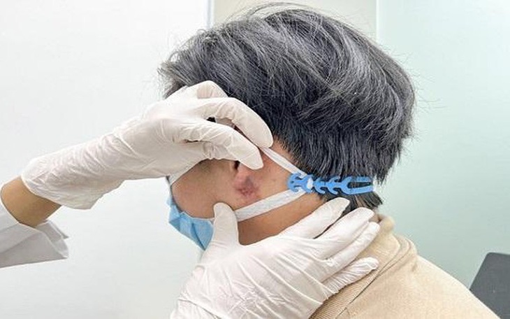 Hiểm họa từ trào lưu nam giới tạo tai Phật bằng tiêm filler