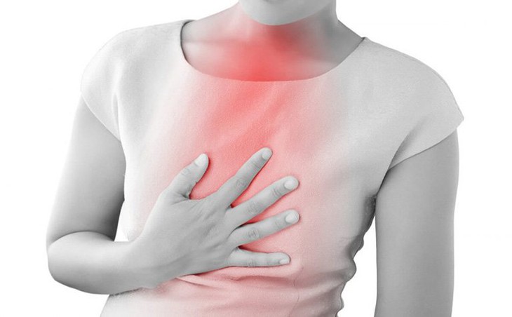 5 điều cần biết về bệnh trào ngược dạ dày thực quản - Ảnh 1.