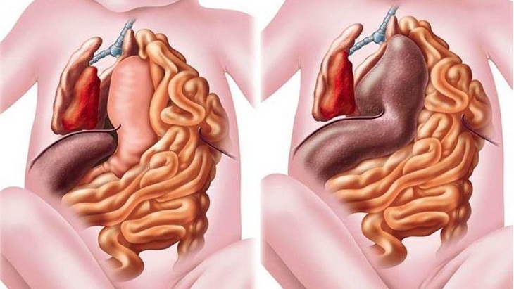 Thoát vị hoành bẩm sinh: Biểu hiện, nguyên nhân và điều trị - Ảnh 4.