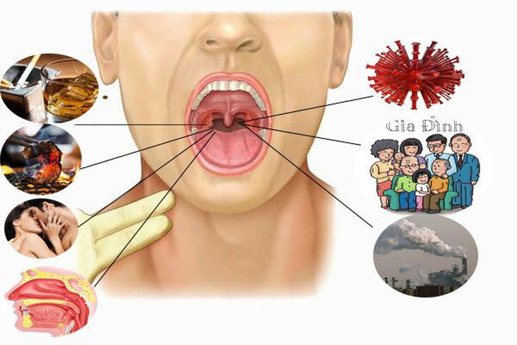 Những nguyên nhân gây ung thư vòm họng. Những nguyên nhân gây ung thư vòm họng.