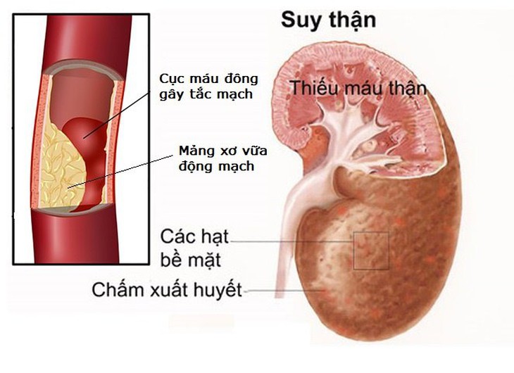 Tổn thương thận do tăng huyết áp - Ảnh 3.