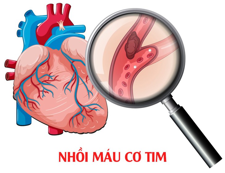 Nhồi máu cơ tim nguy hiểm ra sao và cách xử trí đúng - Ảnh 1.