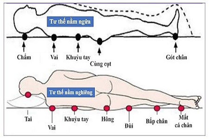 Đừng để loét tỳ đè gây cản trở cuộc sống hằng ngày của bạn - Ảnh 1. Đừng để loét tỳ đè gây cản trở cuộc sống hằng ngày của bạn - Ảnh 1.