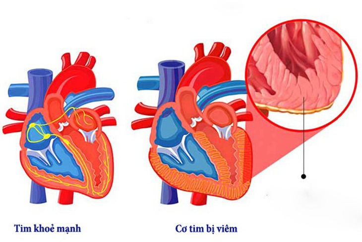 Cảnh giác với biến chứng tim mạch hậu COVID-19 - Ảnh 2.