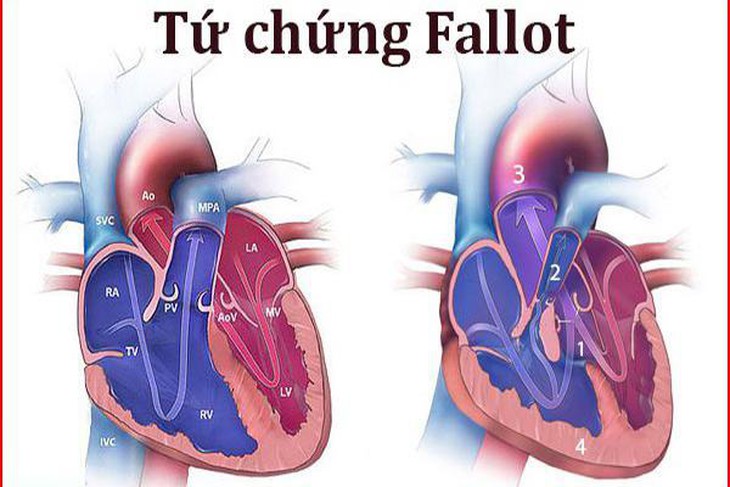 Những dấu hiệu nhận biết tứ chứng Fallot - Ảnh 2.