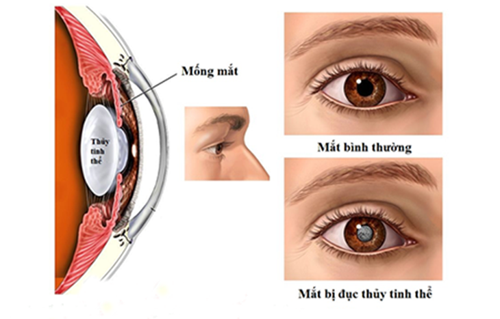 Nguyên nhân gây đục thủy tinh thể - Ảnh 1.