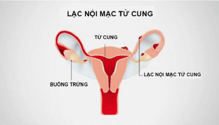 Nguyên nhân nào gây ra hiện tượng co thắt âm đạo? - Ảnh 4.