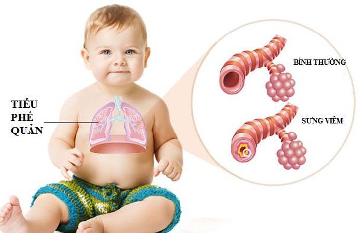 Có nên cho trẻ uống thuốc ho khi bị viêm tiểu phế quản không? - Ảnh 1.