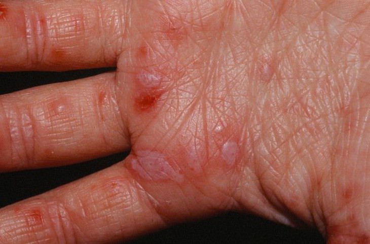 Bệnh tay chân miệng ở người lớn không thể chủ quan - Ảnh 3.