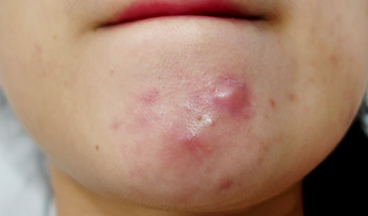 Các hoạt chất điều trị mụn trứng cá từ nhẹ đến nặng - Ảnh 1.