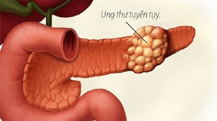 Ung thư tuỵ: Các yếu tố nguy cơ, biểu hiện và chẩn đoán điều trị - Ảnh 2.
