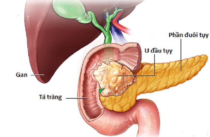Ung thư tuỵ: Các yếu tố nguy cơ, biểu hiện và chẩn đoán điều trị - Ảnh 1.