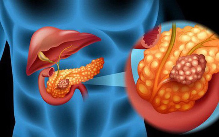 Ung thư tụy: Nguyên nhân, biểu hiện, chẩn đoán  và các phương pháp điều trị