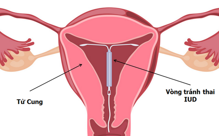 Ưu và nhược điểm của 10 biện pháp tránh thai hiện nay bạn cần biết - Ảnh 5.