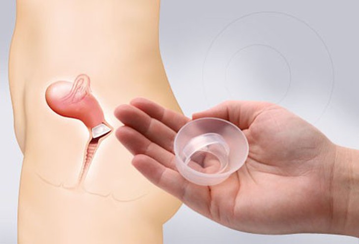 Ưu và nhược điểm của 10 biện pháp tránh thai hiện nay bạn cần biết - Ảnh 7.