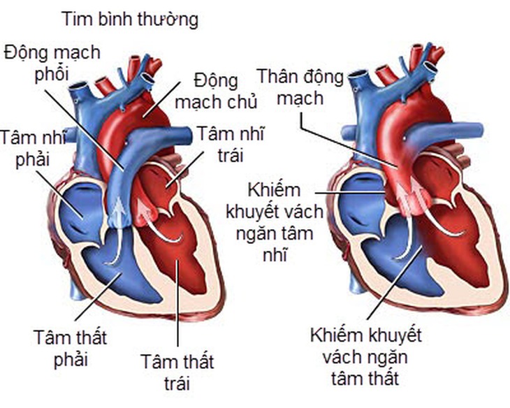 Tim bẩm sinh: Nguyên nhân, biểu hiện và khi nào cần phẫu thuật? - Ảnh 3.