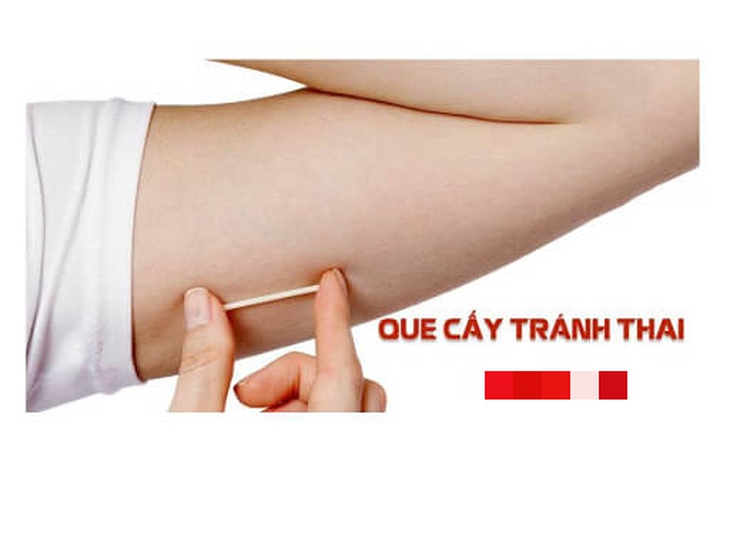 Ưu và nhược điểm của 10 biện pháp tránh thai hiện nay bạn cần biết - Ảnh 6.
