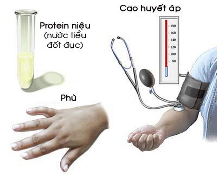 Tiền sản giật - biến chứng nguy hiểm của tăng huyết áp thai kỳ không nên chủ quan - Ảnh 2. Tiền sản giật - biến chứng nguy hiểm của tăng huyết áp thai kỳ không nên chủ quan - Ảnh 2.