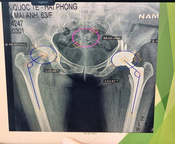 Hải Phòng: Có hay không sai sót chuyên môn sau phẫu thuật thay khớp hàng bị lệch chi? - Ảnh 2. Hải Phòng: Có hay không sai sót chuyên môn sau phẫu thuật thay khớp hàng bị lệch chi? - Ảnh 2.