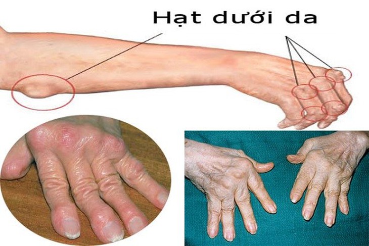 Sử dụng thuốc chống viêm an toàn trong điều trị viêm khớp dạng thấp - Ảnh 1.
