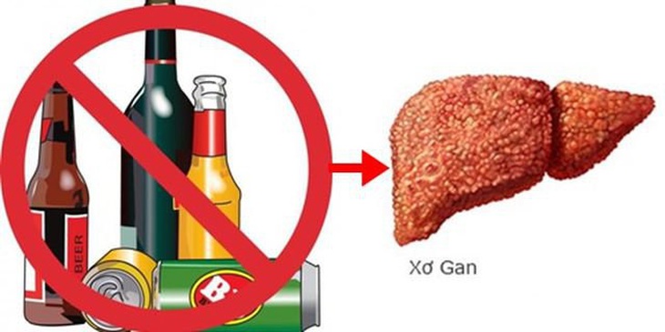Xơ gan: Nguyên nhân, phân loại và chẩn đoán điều trị - Ảnh 2. Xơ gan: Nguyên nhân, phân loại và chẩn đoán điều trị - Ảnh 2.
