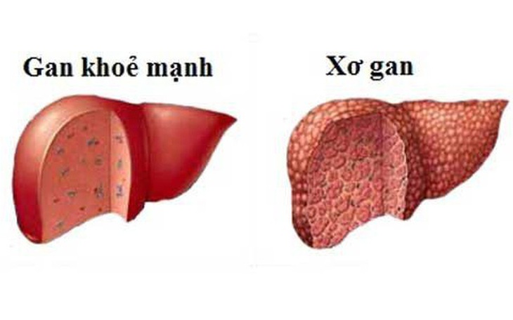 Xơ gan: Nguyên nhân, phân loại và chẩn đoán điều trị