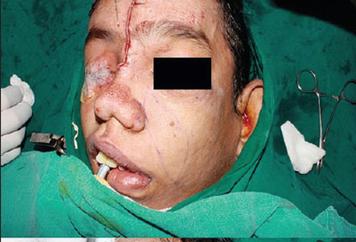 Hội chứng người voi- Nguyên nhân, triệu chứng và biện pháp điều trị - Ảnh 5.