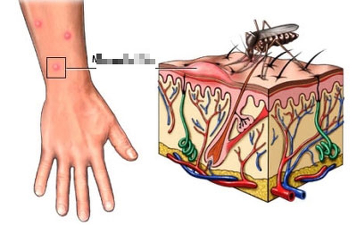 Chăm sóc dinh dưỡng cho người sau khi khỏi sốt xuất huyết - Ảnh 2.
