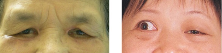 Sụp mi mắt: Nguyên nhân, triệu chứng, điều trị và cách khắc phục - Ảnh 2.