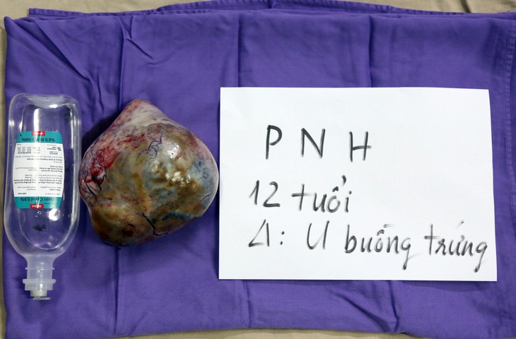 Bé gái 12 tuổi 'gánh' u quái 12 kg - Ảnh 2.