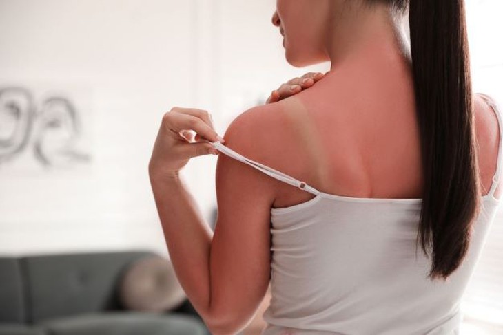 Mách bạn mẹo chữa cháy nắng hiệu quả - Ảnh 1.