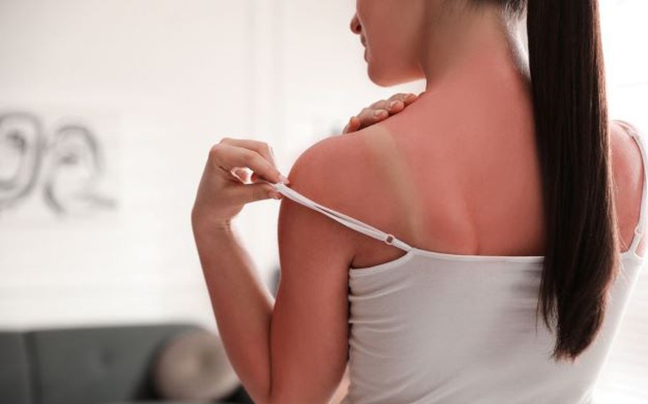 Mách bạn mẹo chữa cháy nắng hiệu quả