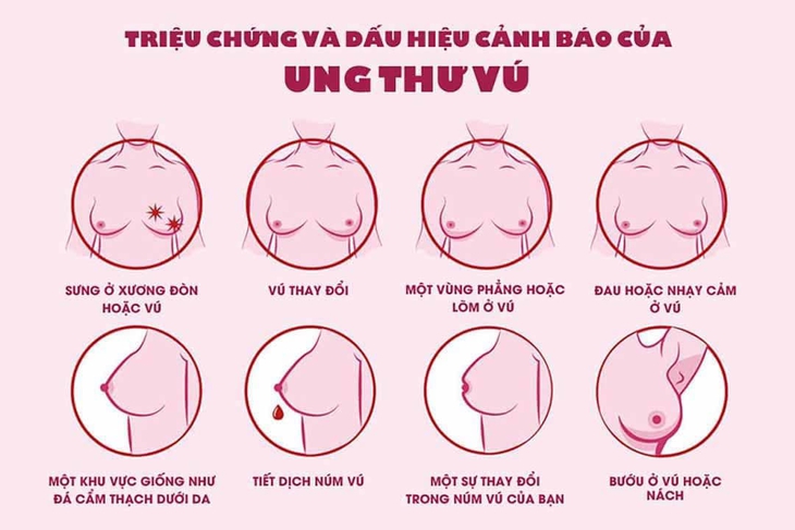 Có phải lúc nào sờ thấy u mới là ung thư vú? - Ảnh 2. Có phải lúc nào sờ thấy u mới là ung thư vú? - Ảnh 2.
