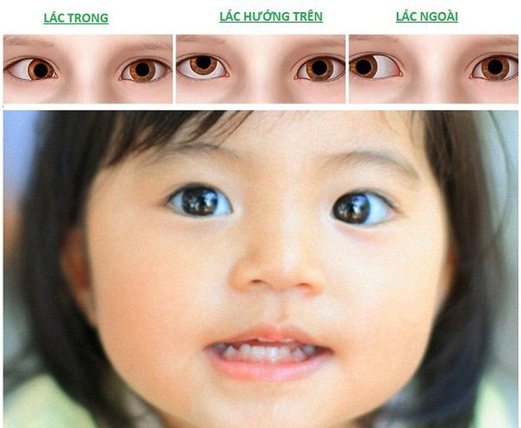 Lác mắt ở trẻ sơ sinh cần làm gì? - Ảnh 3. Lác mắt ở trẻ sơ sinh cần làm gì? - Ảnh 3.