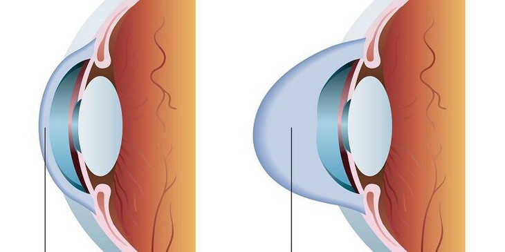 Nhận biết và điều trị giác mạc hình chóp - Ảnh 2. Nhận biết và điều trị giác mạc hình chóp - Ảnh 2.