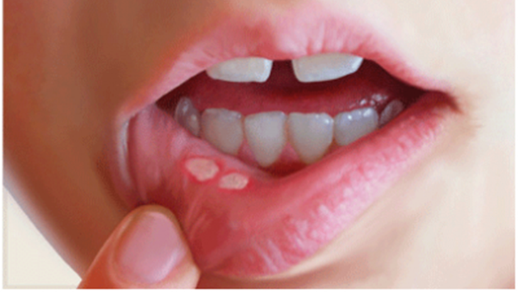 Loét miệng, nguyên nhân và cách chữa trị - Ảnh 1.