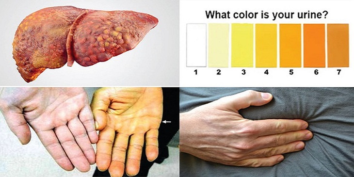 Làm gì để ngăn ngừa ung thư gan?- Ảnh 1.