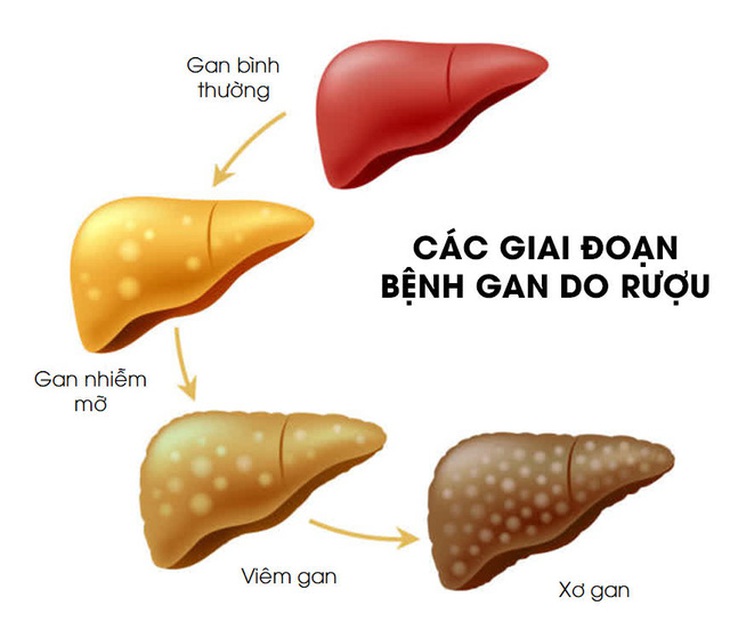 Uống rượu bia nhiều cần phải biết các bệnh lý về gan do rượu - Ảnh 1. Uống rượu bia nhiều cần phải biết các bệnh lý về gan do rượu - Ảnh 1.