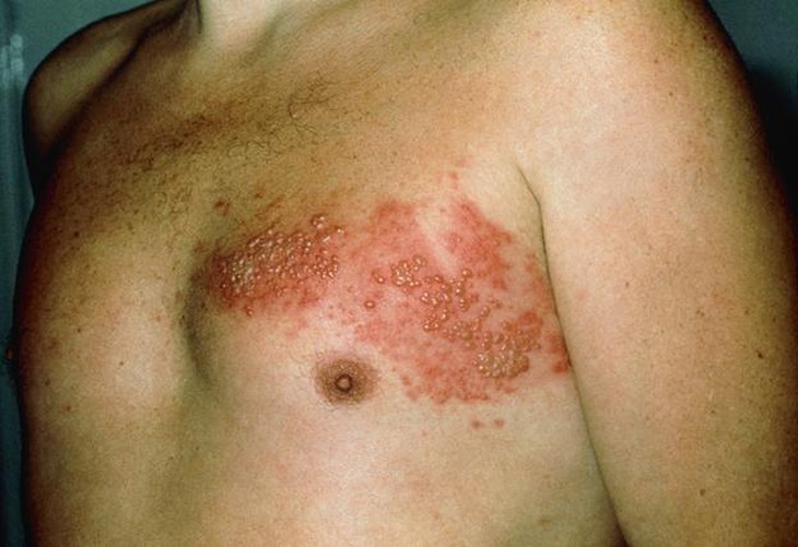 Điều trị, đề phòng bệnh zona thần kinh tái phát  - Ảnh 3.