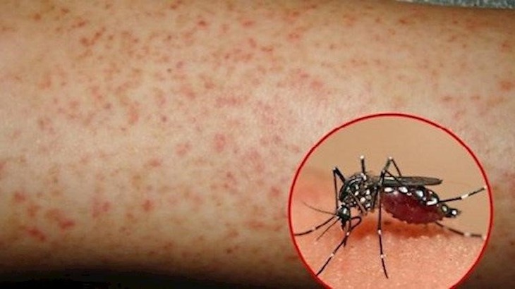 Đã có hơn 43.600 ca mắc, 22 người tử vong vì sốt xuất huyết: Bộ Y tế tiếp tục yêu cầu quyết liệt phòng chống - Ảnh 1. Đã có hơn 43.600 ca mắc, 22 người tử vong vì sốt xuất huyết: Bộ Y tế tiếp tục yêu cầu quyết liệt phòng chống - Ảnh 1.