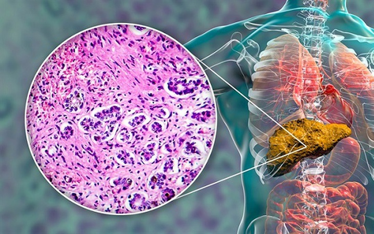 Vàng da, mệt mỏi, chán ăn… Cẩn thận với xơ gan do rượu