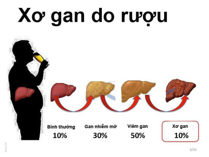 Những biến chứng của xơ gan do rượu và cách khắc phục - Ảnh 1. Những biến chứng của xơ gan do rượu và cách khắc phục - Ảnh 1.