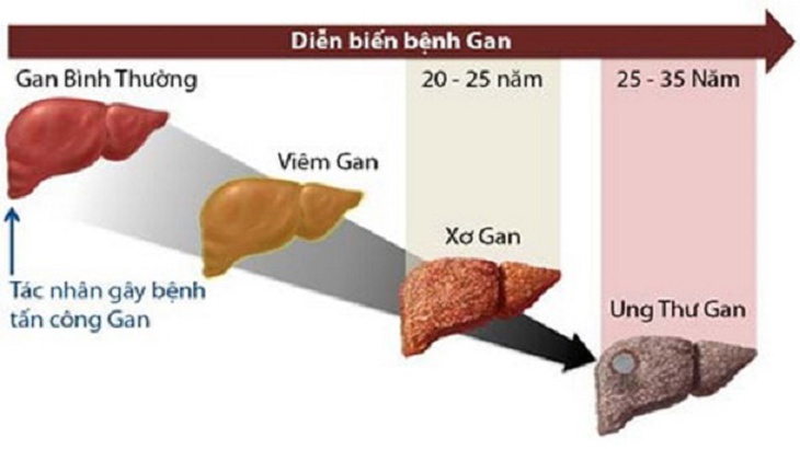 Vàng da, mệt mỏi, chán ăn…  cẩn thận với xơ gan do rượu - Ảnh 1.