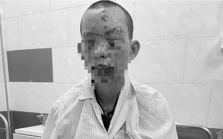 Mất thị lực, cháy sém toàn thân do dùng điện thoại đang sạc