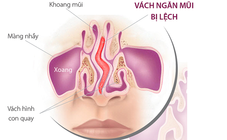 Vẹo vách ngăn mũi ở trẻ và cách điều trị - Ảnh 1. Vẹo vách ngăn mũi ở trẻ và cách điều trị - Ảnh 1.