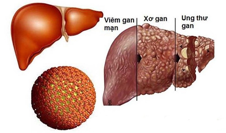 Nguyên nhân gây bệnh gan mạn tính ở trẻ em - Ảnh 2.